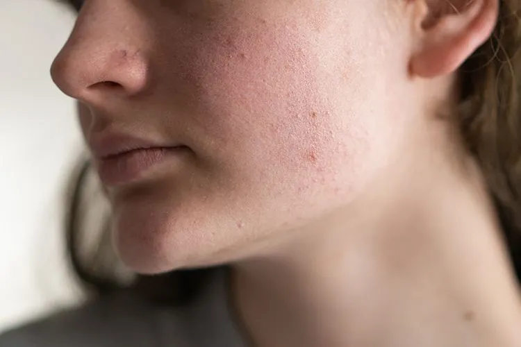 LED mask for rosacea and sensitive skin